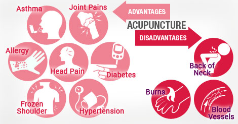 Advantages and Disadvantages of Acupuncture