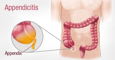 Appendicitis