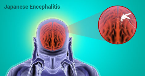 Japanese Encephalitis