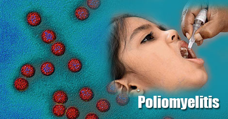 Poliomyelitis