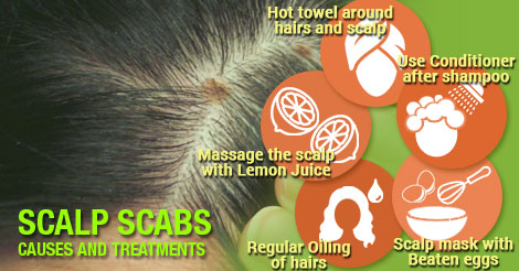 Scalp Scabs: Causes and Treatments