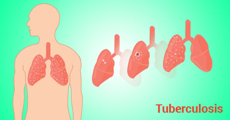 Tuberculosis