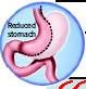 Scalpel Helps Teen Fight Flab, Docs Advise Caution Scalpel Helps Teen Fight Flab, Docs Advise Caution
