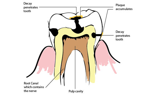 dental decay