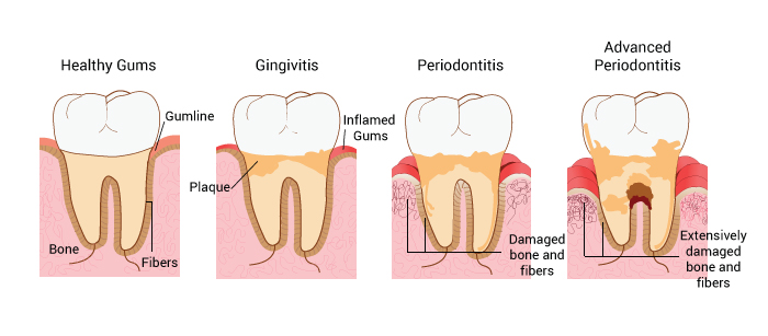 gum disease