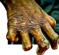 Leprosy Still Plagues TN