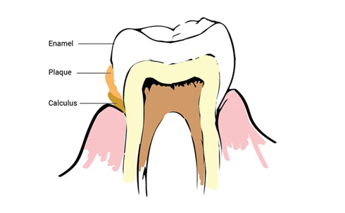 plaque and tartar
